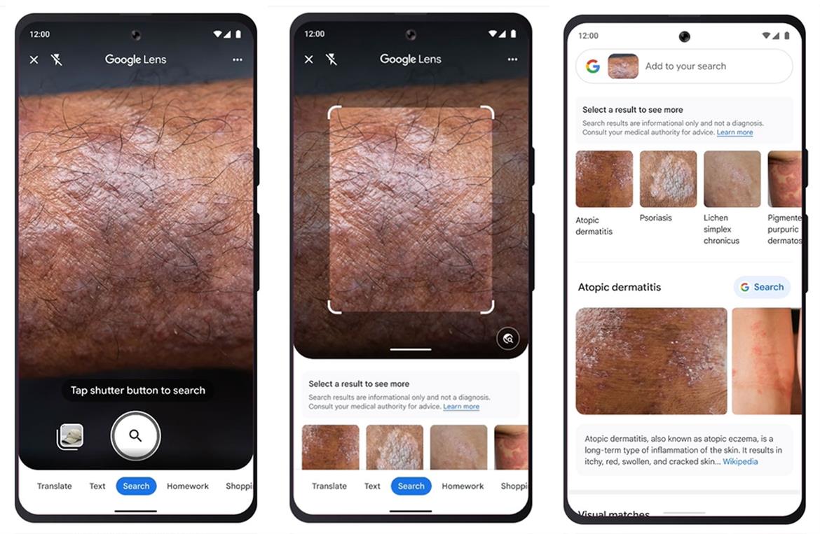 Forget WebMD, Google Lens Can Identify Your Rash, Mole And Other Skin Conditions
